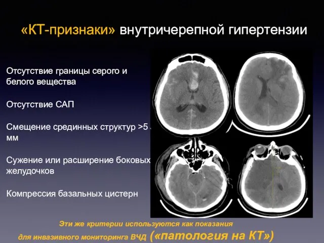 «КТ-признаки» внутричерепной гипертензии Отсутствие границы серого и белого вещества Отсутствие САП