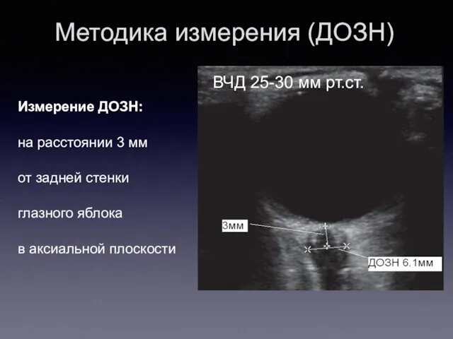 Методика измерения (ДОЗН) Измерение ДОЗН: на расстоянии 3 мм от задней