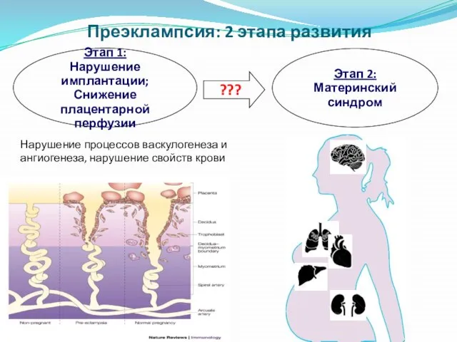 Преэклампсия: 2 этапа развития Этап 1: Нарушение имплантации; Снижение плацентарной перфузии