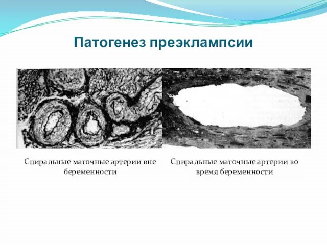 Патогенез преэклампсии Спиральные маточные артерии вне беременности Спиральные маточные артерии во время беременности