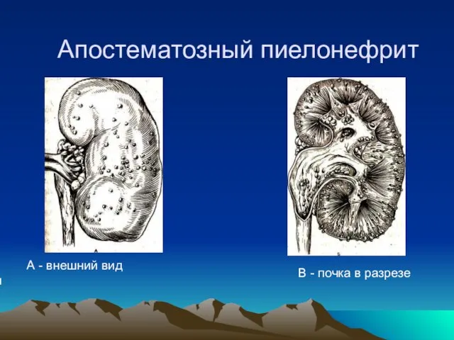 Апостематозный пиелонефрит В - почка в разрезе А - внешний вид почки