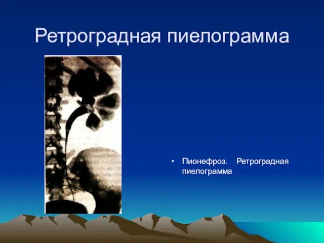 Ретроградная пиелограмма Пионефроз. Ретроградная пиелограмма