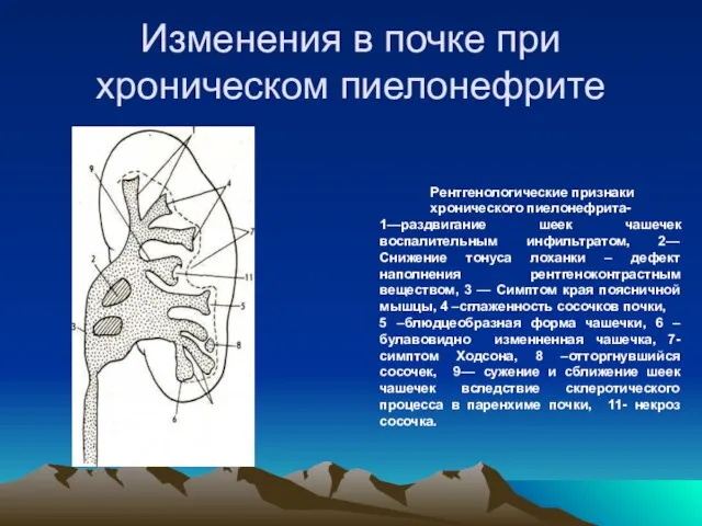 Изменения в почке при хроническом пиелонефрите Pентгенологические признаки хронического пиелонефрита- 1—раздвигание