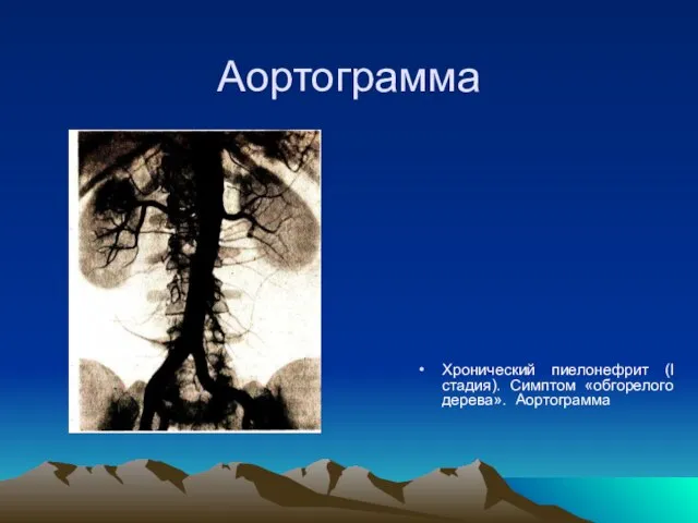 Аортограмма Хронический пиелонефрит (I стадия). Симптом «обгорелого дерева». Аортограмма