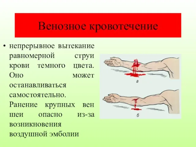 Венозное кровотечение непрерывное вытекание равномерной струи крови темного цвета. Оно может