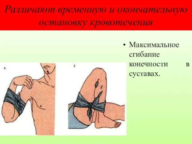 Различают временную и окончательную остановку кровотечения Максимальное сгибание конечности в суставах.