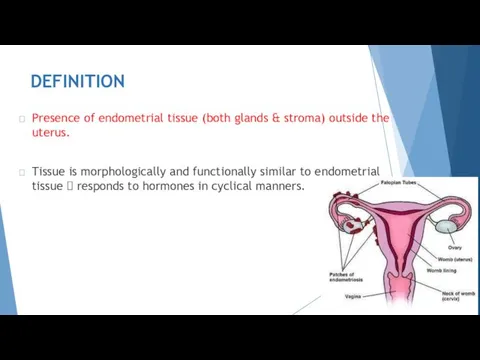 DEFINITION  Presence of endometrial tissue (both glands & stroma) outside