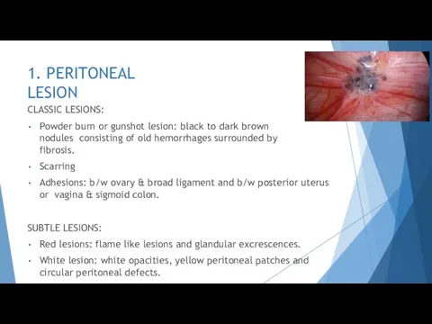 1. PERITONEAL LESION CLASSIC LESIONS: Powder burn or gunshot lesion: black