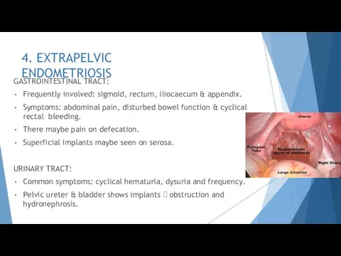4. EXTRAPELVIC ENDOMETRIOSIS GASTROINTESTINAL TRACT: Frequently involved: sigmoid, rectum, iliocaecum &