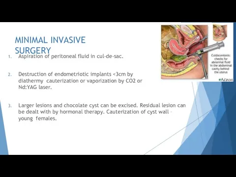 MINIMAL INVASIVE SURGERY Aspiration of peritoneal fluid in cul-de-sac. Destruction of