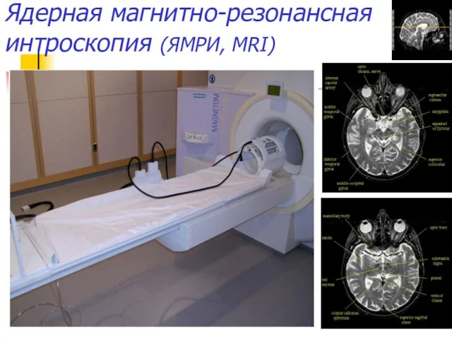 Ядерная магнитно-резонансная интроскопия (ЯМРИ, MRI)