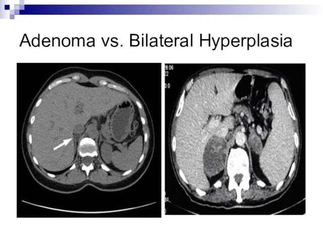 Adenoma vs. Bilateral Hyperplasia