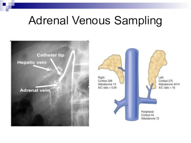 Adrenal Venous Sampling