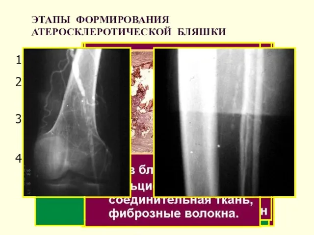 ЭТАПЫ ФОРМИРОВАНИЯ АТЕРОСКЛЕРОТИЧЕСКОЙ БЛЯШКИ 1. Повреждение эндотелия 2. Проникновение липидов в