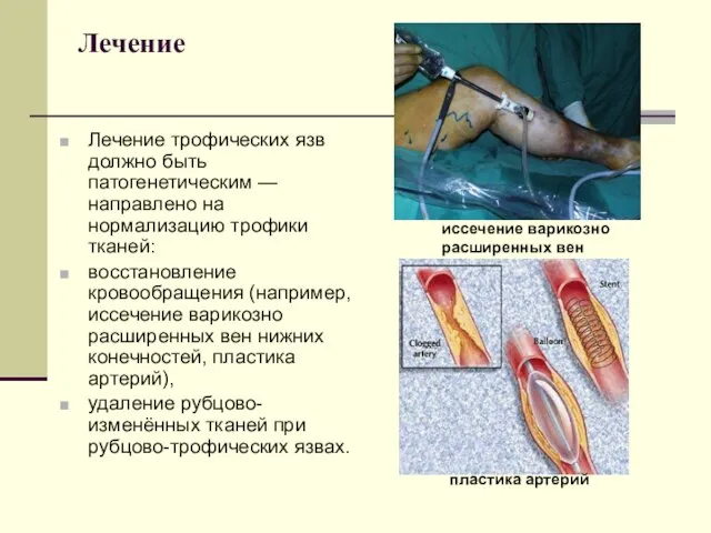Лечение Лечение трофических язв должно быть патогенетическим —направлено на нормализацию трофики