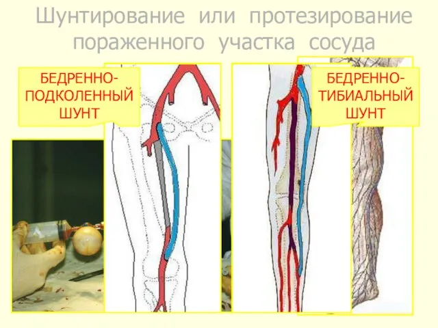 Шунтирование или протезирование пораженного участка сосуда АУТОВЕНОЗНОЕ ШУНТИРОВАНИЕ БЕДРЕННО-ПОДКОЛЕННЫЙ ШУНТ БЕДРЕННО-ТИБИАЛЬНЫЙ ШУНТ