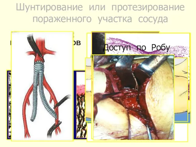 Шунтирование или протезирование пораженного участка сосуда СИНТЕТИЧЕСКИЕ ПРОТЕЗЫ СОСУДОВ ТКАНЫЕ ПЛЕТЕНЫЕ ВЯЗАНЫЕ ПТФЭ Доступ по Робу