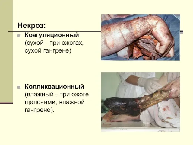 Некроз: Коагуляционный (сухой - при ожогах, сухой гангрене) Колликвационный (влажный - при ожоге щелочами, влажной гангрене).