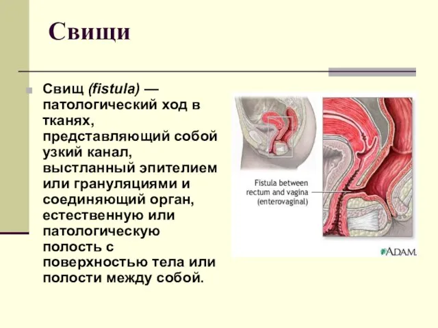Свищи Свищ (fistula) — патологический ход в тканях, представляющий собой узкий