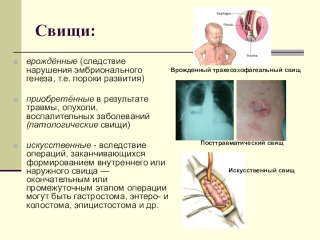 Свищи: врождённые (следствие нарушения эмбрионального генеза, т.е. пороки развития) приобретённые в