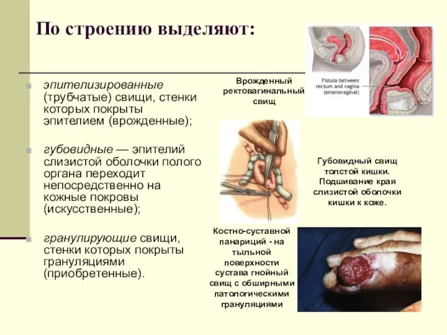 По строению выделяют: эпителизированные (трубчатые) свищи, стенки которых покрыты эпителием (врожденные);