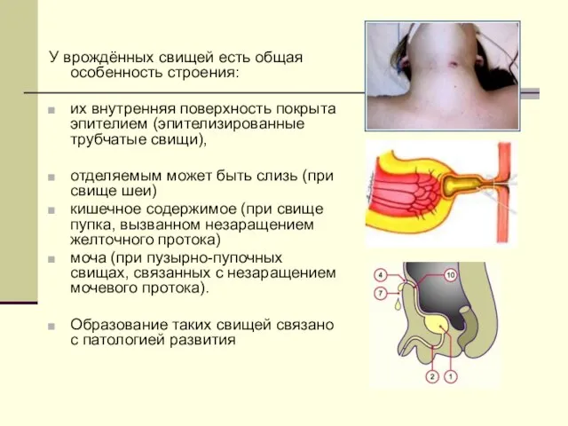 У врождённых свищей есть общая особенность строения: их внутренняя поверхность покрыта