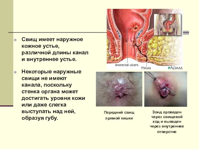 Свищ имеет наружное кожное устье, различной длины канал и внутреннее устье.