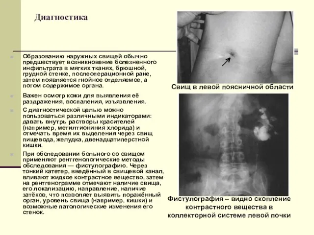 Диагностика Образованию наружных свищей обычно предшествует возникновение болезненного инфильтрата в мягких