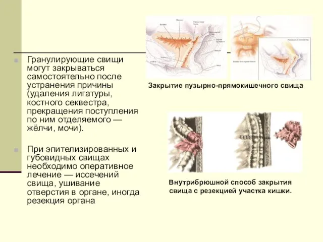 Гранулирующие свищи могут закрываться самостоятельно после устранения причины (удаления лигатуры, костного