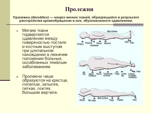 Пролежни Мягкие ткани подвергаются сдавлению между поверхностью постели и костным выступом