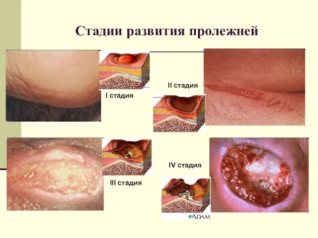 Стадии развития пролежней I стадия II стадия III стадия IV стадия