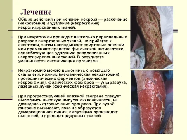 Лечение Общие действия при лечении некроза — рассечение (некротомия) и удаление