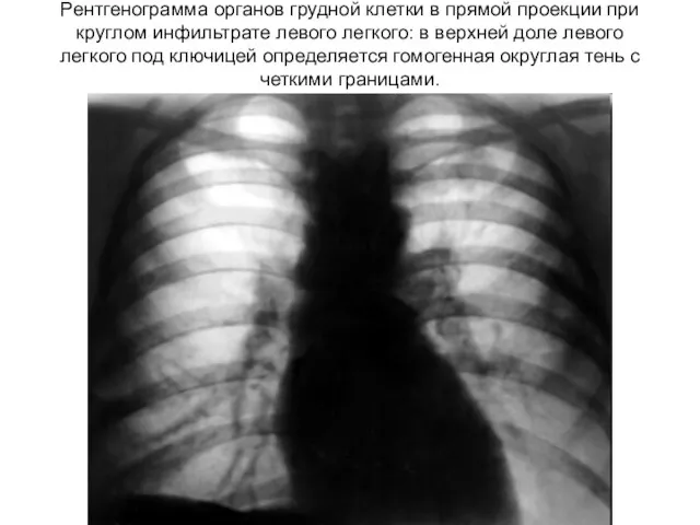 Рентгенограмма органов грудной клетки в прямой проекции при круглом инфильтрате левого