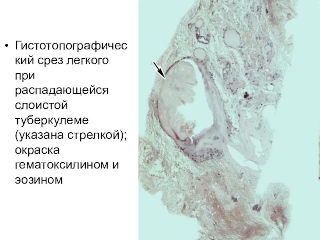 Гистотопографический срез легкого при распадающейся слоистой туберкулеме (указана стрелкой); окраска гематоксилином и эозином