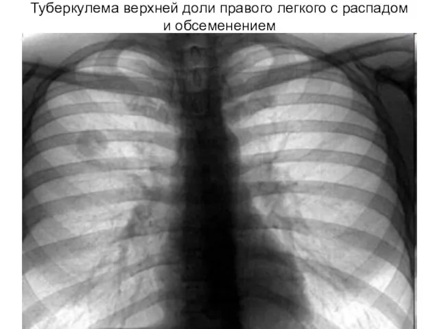 Туберкулема верхней доли правого легкого с распадом и обсеменением