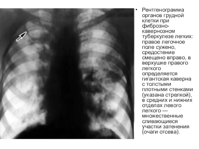 Рентгенограмма органов грудной клетки при фиброзно-кавернозном туберкулезе легких: правое легочное поле