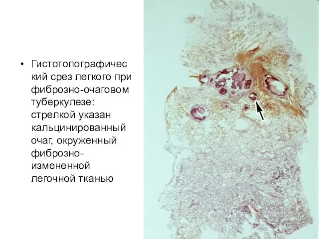 Гистотопографический срез легкого при фиброзно-очаговом туберкулезе: стрелкой указан кальцинированный очаг, окруженный фиброзно-измененной легочной тканью