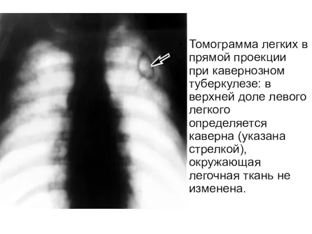 Томограмма легких в прямой проекции при кавернозном туберкулезе: в верхней доле