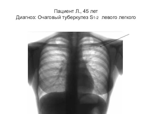 Пациент Л., 45 лет Диагноз: Очаговый туберкулез S1-2 левого легкого