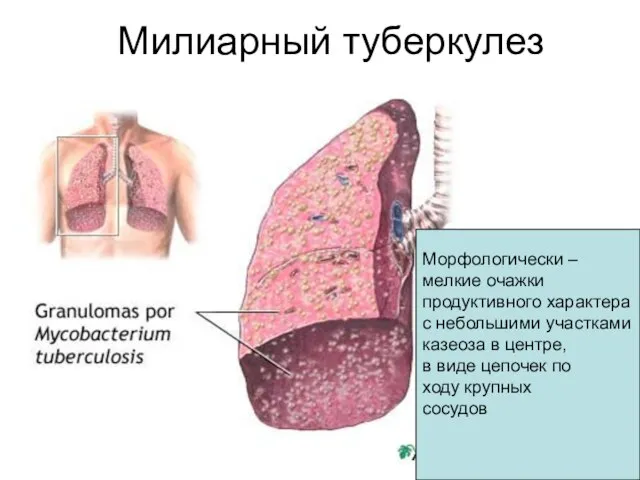 Милиарный туберкулез Морфологически – мелкие очажки продуктивного характера с небольшими участками