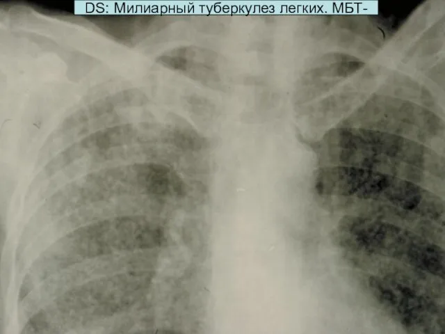 DS: Милиарный туберкулез легких. МБТ-