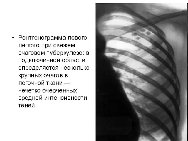 Рентгенограмма левого легкого при свежем очаговом туберкулезе: в подключичной области определяется