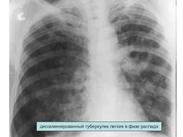 диссеминированный туберкулез легких в фазе распада