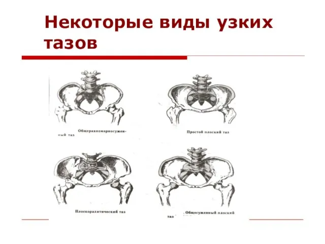 Некоторые виды узких тазов