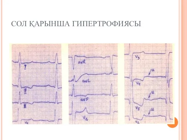 СОЛ ҚАРЫНША ГИПЕРТРОФИЯСЫ