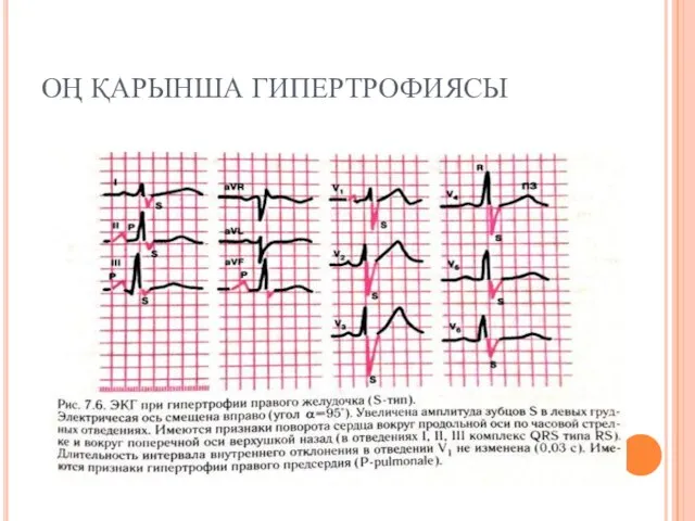 ОҢ ҚАРЫНША ГИПЕРТРОФИЯСЫ