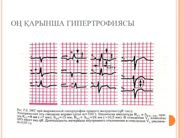 ОҢ ҚАРЫНША ГИПЕРТРОФИЯСЫ