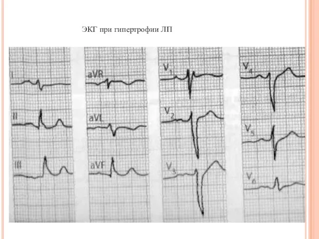 ЭКГ при гипертрофии ЛП