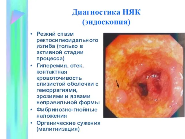 Диагностика НЯК (эндоскопия) Резкий спазм ректосигмоидального изгиба (только в активной стадии