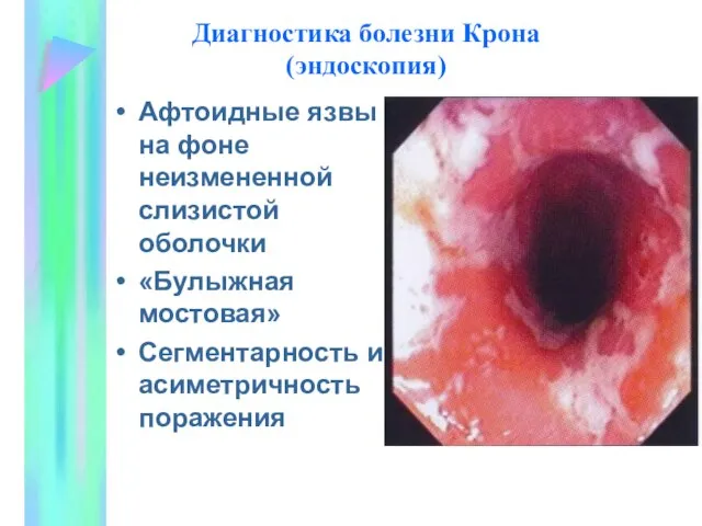 Диагностика болезни Крона (эндоскопия) Афтоидные язвы на фоне неизмененной слизистой оболочки